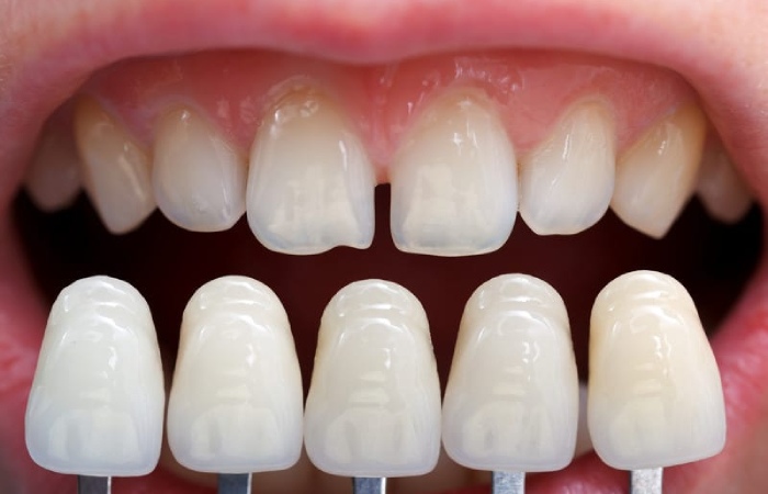 All porcelain or tooth-coloured crowns. dental crown