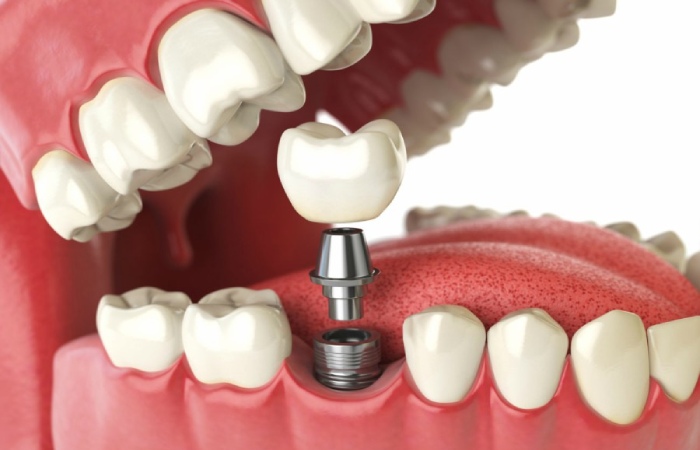 The cost of follow-up treatments after assignment of the dental implants