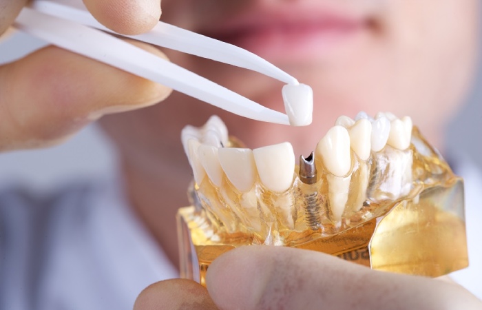 The cost of the dental implant and components