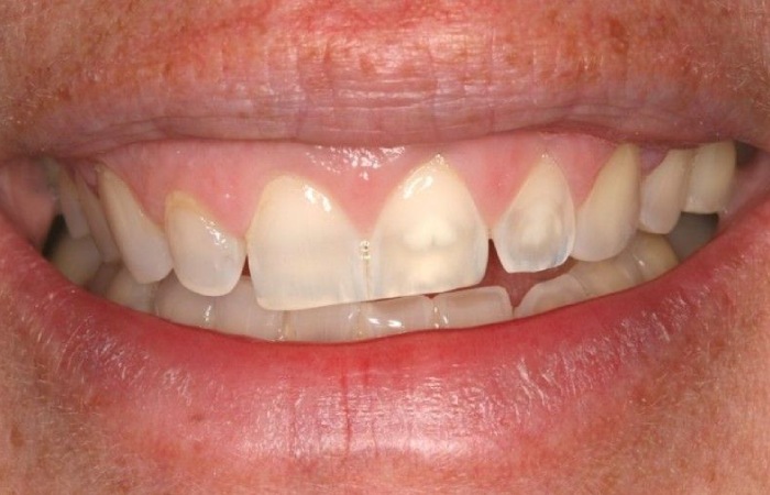 What occurs if the teeth do not lighten up evenly Naturally Whiten