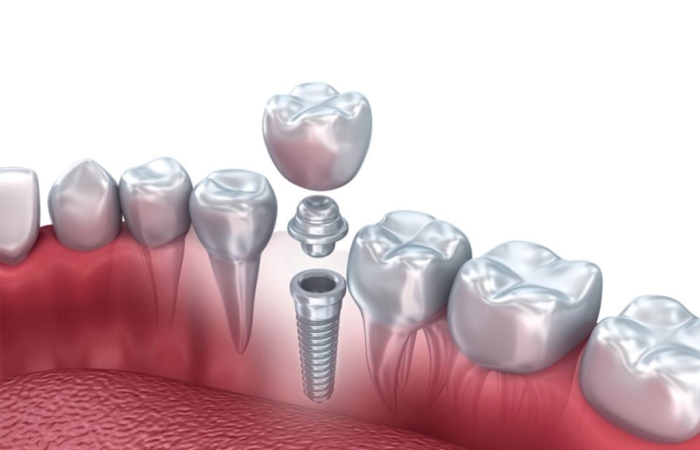 Why are dental implants so expensive dental implants